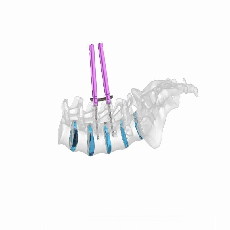 Auxein - Vertaux MIS - Система для транспедикулярної фіксації хребта (4 гвинти)